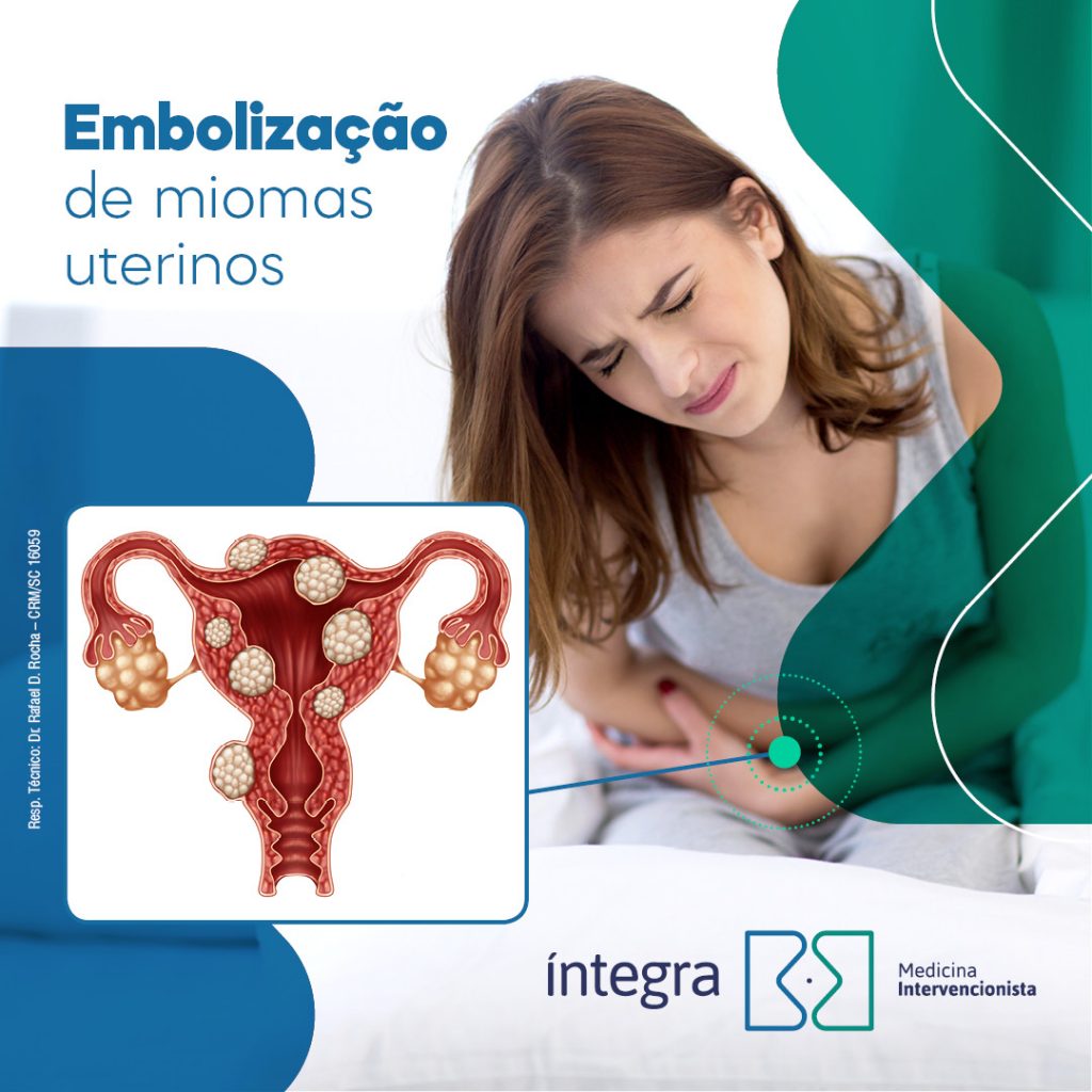 Embolização de miomas uterinos