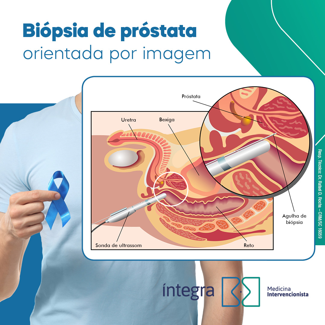 A importância da biópsia de próstata orientada por ultrassom